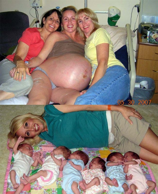 Before and after sixtuplets